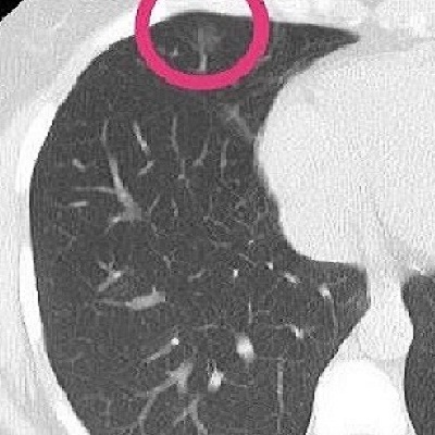 3D CNN Lung Nodule Detection